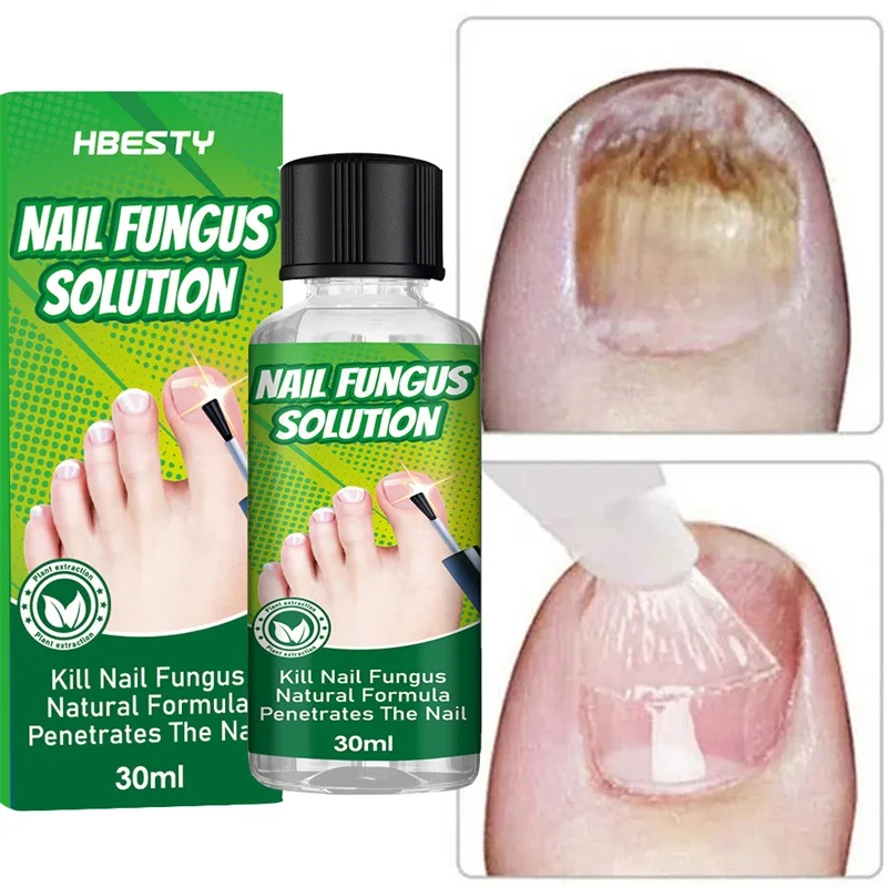 7 Days Nail Fungal Treatment Essential Oil Effective Removal Foot Toe Nail Fungus Serum Anti Infection Onychomycosis Repair Care
7 Days Nail Fungal Treatment Essential Oil Effective Removal Foot Toe Nail Fungus Serum Anti Infection Onychomycosis Repair Care