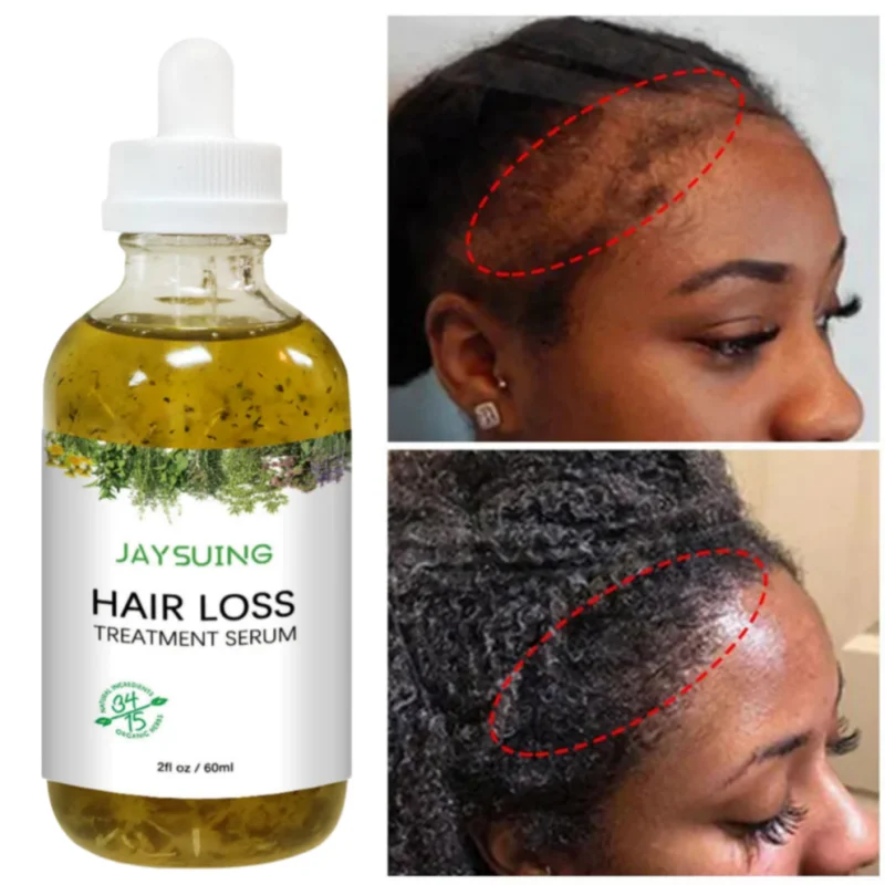 60ML Fast Hair Growth Serum African Crazy Regrowth Traction Alopecia Prevent Hair Loss Bald Spot Thinnin Nourish Scalp Treat Oil
60ML Fast Hair Growth Serum African Crazy Regrowth Traction Alopecia Prevent Hair Loss Bald Spot Thinnin Nourish Scalp Treat Oil