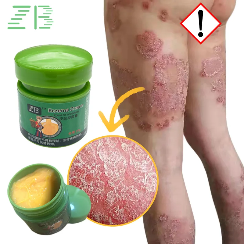 

Крем при псориазе дерматите экземе, 20 г, антибактериальная мазь, эффективное средство против зуда для здоровья и ухода за кожей