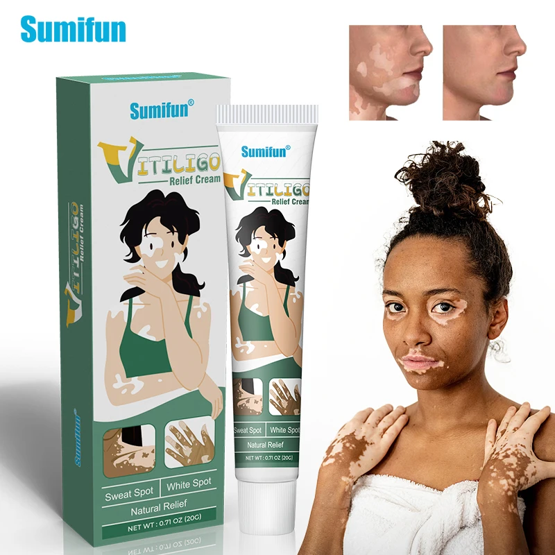 

Лечебный крем Sumifun для Vitiligo, антибактериальная мазь с белыми пятнами, локализованная восстанавливающая леопластика, медицинские травы для красоты и здоровья, 20 г