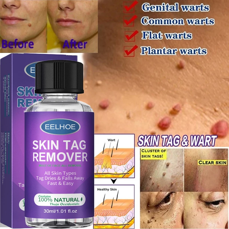 Removing Against Moles Liquid Treatment Papillomas 24hours Removal Of Warts Liquid From Skin Tags Remover Anti Verruca Remedy
Removing Against Moles Liquid Treatment Papillomas 24hours Removal Of Warts Liquid From Skin Tags Remover Anti Verruca Remedy