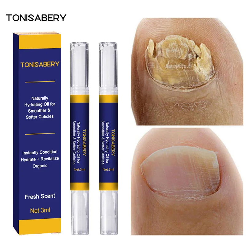 2 шт., ручка для лечения грибка ногтей 
2 шт., ручка для лечения грибка ногтей