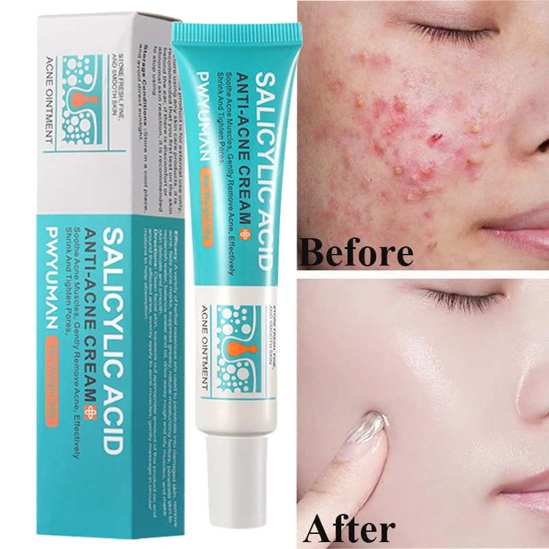 Salicylic Acid Acne Removal Cream Face Treatment Moisturizing Oil Control Shrink Pore Repair Fade Redness Pimple Scar Skin Care
Salicylic Acid Acne Removal Cream Face Treatment Moisturizing Oil Control Shrink Pore Repair Fade Redness Pimple Scar Skin Care