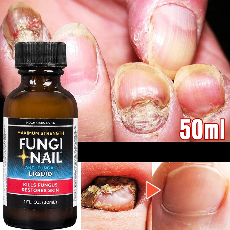 U.S.A Nail Fungus Treatment Feet Care Essence Nails Foot Repair Toe Nail Fungal Removal Gel Anti Infection
U.S.A Nail Fungus Treatment Feet Care Essence Nails Foot Repair Toe Nail Fungal Removal Gel Anti Infection