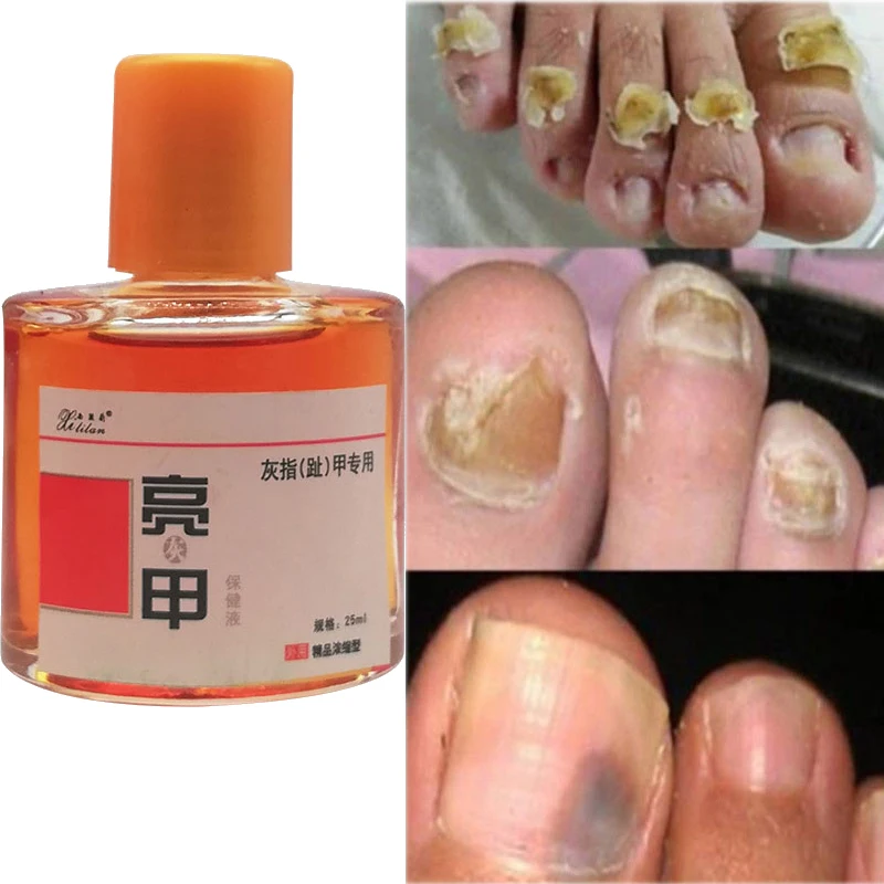 3/5pcs 25ml Fungal Nail Treat Liquid Feet Anti Infection Solution Foot Repair Essence Toe Onychomycosis Removal Care Dressing
3/5pcs 25ml Fungal Nail Treat Liquid Feet Anti Infection Solution Foot Repair Essence Toe Onychomycosis Removal Care Dressing