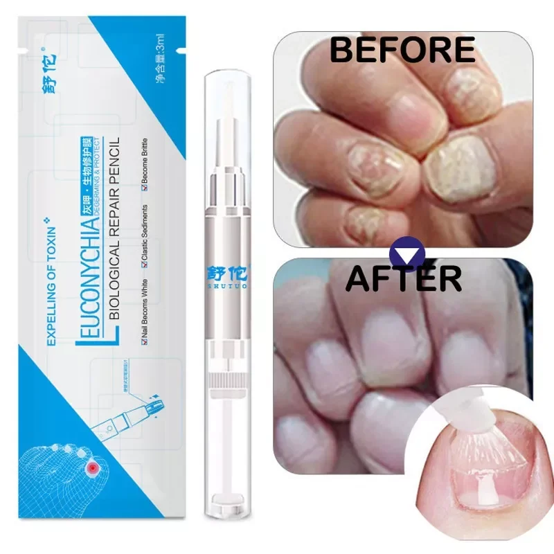 NEW 3ML Nail Treatment Pen Anti Fungal Nail Finger Toe Chinese Medicine Health Care Liquid TSLM2
NEW 3ML Nail Treatment Pen Anti Fungal Nail Finger Toe Chinese Medicine Health Care Liquid TSLM2