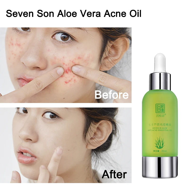 Rungenyuan Seven Son Aloe Vera Acne Oil 35ml regola l'olio per prevenire l'acne e riparare la pelle danneggiata Face Oil Massage
Rungenyuan Seven Son Aloe Vera Acne Oil 35ml regola l'olio per prevenire l'acne e riparare la pelle danneggiata Face Oil Massage