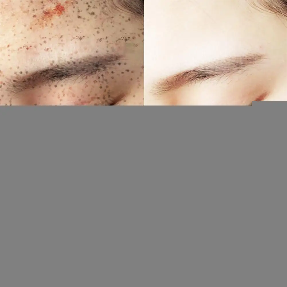 Эффективный отбеливающий крем для веснушек, удаляет темные Антивозрастные мелазмы, удаляет меланин, увлажняет пятна света Z7k2
Эффективный отбеливающий крем для веснушек, удаляет темные Антивозрастные мелазмы, удаляет меланин, увлажняет пятна света Z7k2