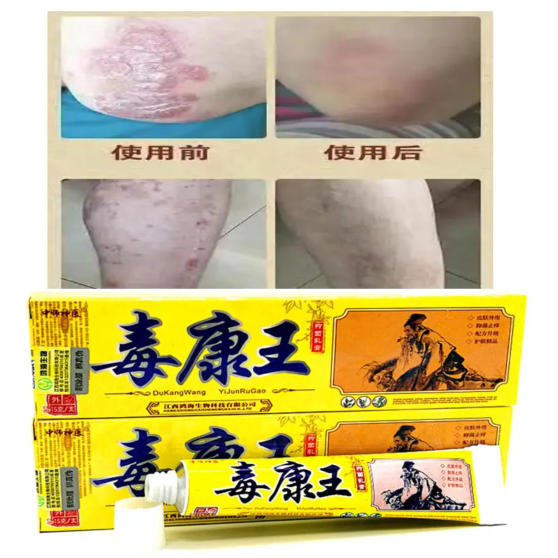 15g Psoriasis Cream Dermatitis Eczematoid Ointment Psoriasis Skin Rash Urticaria Desquamation Antibacterial Cream
15g Psoriasis Cream Dermatitis Eczematoid Ointment Psoriasis Skin Rash Urticaria Desquamation Antibacterial Cream