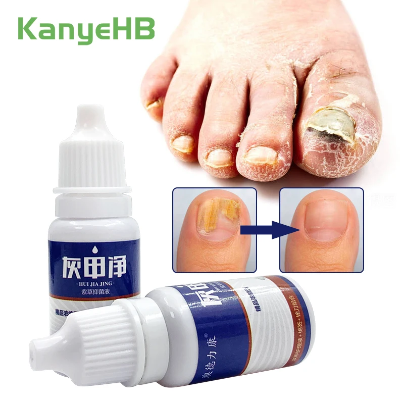 2Pcs Nail Fungus Remove Essence Liquid Bright Nail Repair Anti Infection Foot Care Onychomycosis Treatment Medicined LiquidA1133
2Pcs Nail Fungus Remove Essence Liquid Bright Nail Repair Anti Infection Foot Care Onychomycosis Treatment Medicined LiquidA1133