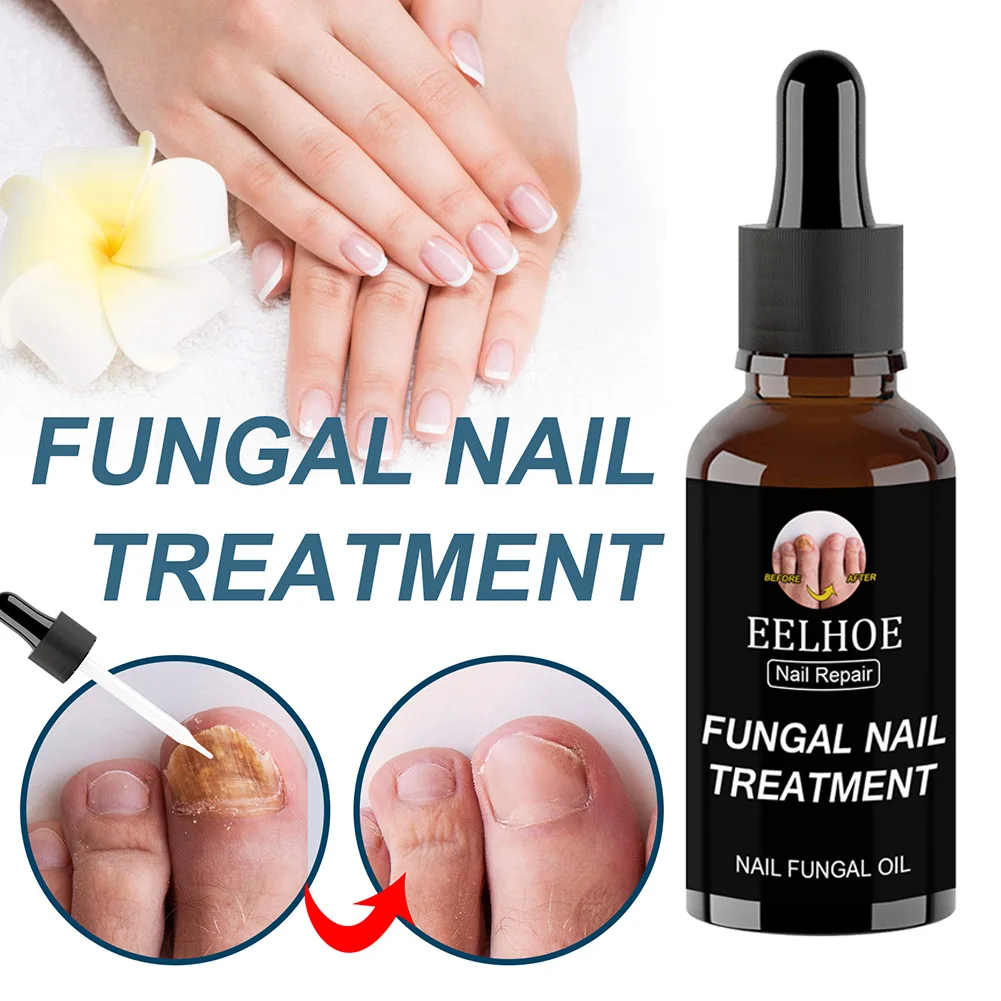 Fungal Nail Repair Essence Feet Care Cracked Discolored Fungal Nails Treatment Serum Anti Infection Nail Repair Nourishing Care
Fungal Nail Repair Essence Feet Care Cracked Discolored Fungal Nails Treatment Serum Anti Infection Nail Repair Nourishing Care