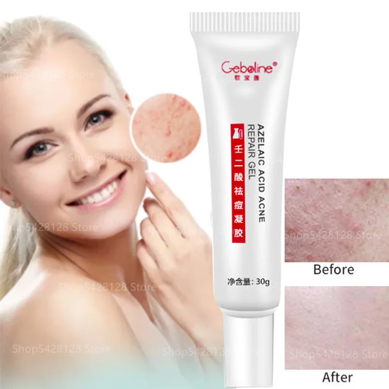 15% Azelaic Acid Gel Salicylic Acid Acne Cream for Women To Dilute Acne Marks To Remove Blackheads and Large Pores
15% Azelaic Acid Gel Salicylic Acid Acne Cream for Women To Dilute Acne Marks To Remove Blackheads and Large Pores