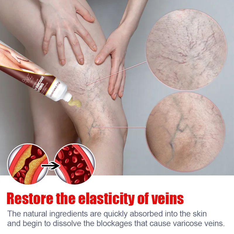 Potent Varicose Veins Relief Cream Leg Vasculitis Phlebitis Spider Shape Vein Pain Relief Ointment Angiitis Removal skin Care
Potent Varicose Veins Relief Cream Leg Vasculitis Phlebitis Spider Shape Vein Pain Relief Ointment Angiitis Removal skin Care