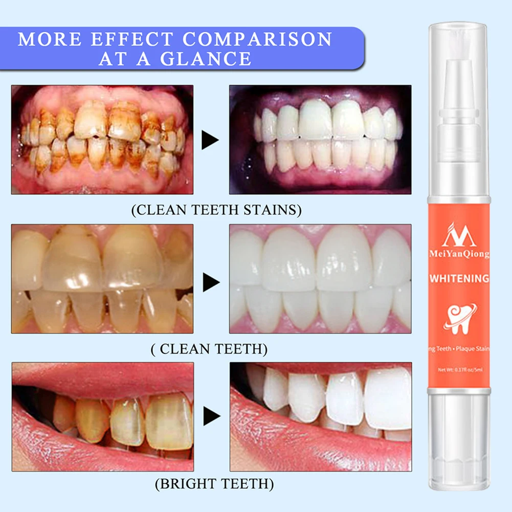 Whitening Pen Tooth Gel Whitener Bleach Remove Stains Instant Smile Teeth Whitening Kit Cleaning Serum Beauty Health Care
Whitening Pen Tooth Gel Whitener Bleach Remove Stains Instant Smile Teeth Whitening Kit Cleaning Serum Beauty Health Care