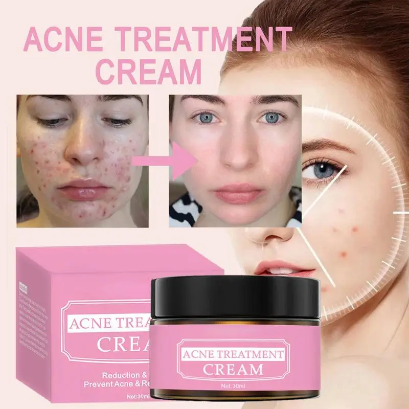 Acne Face Cream Herbal Pimple Scar Removal Shrink Pore Oil Control Moisturizing Facial Treatment Skin Care 
Acne Face Cream Herbal Pimple Scar Removal Shrink Pore Oil Control Moisturizing Facial Treatment Skin Care
