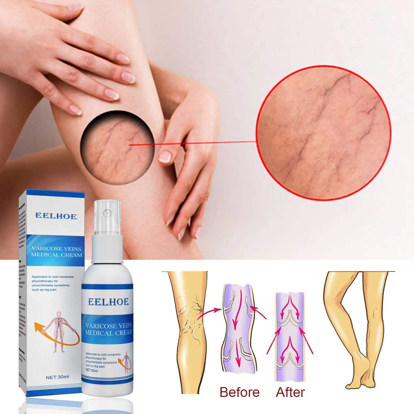 Effective Angiitis Blood Vessel Rotten Legs Varicose Veins Spray Vein Care Repairing Cream Herbal Vasculitis Treatment
Effective Angiitis Blood Vessel Rotten Legs Varicose Veins Spray Vein Care Repairing Cream Herbal Vasculitis Treatment
