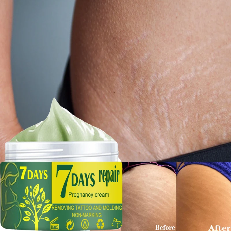 Stretch Marks Remover Cream Pregnancy Maternity Postpartum Obesity Pregnant Women Repair Anti-Winkles Firming Body Cream 30/50g
Stretch Marks Remover Cream Pregnancy Maternity Postpartum Obesity Pregnant Women Repair Anti-Winkles Firming Body Cream 30/50g