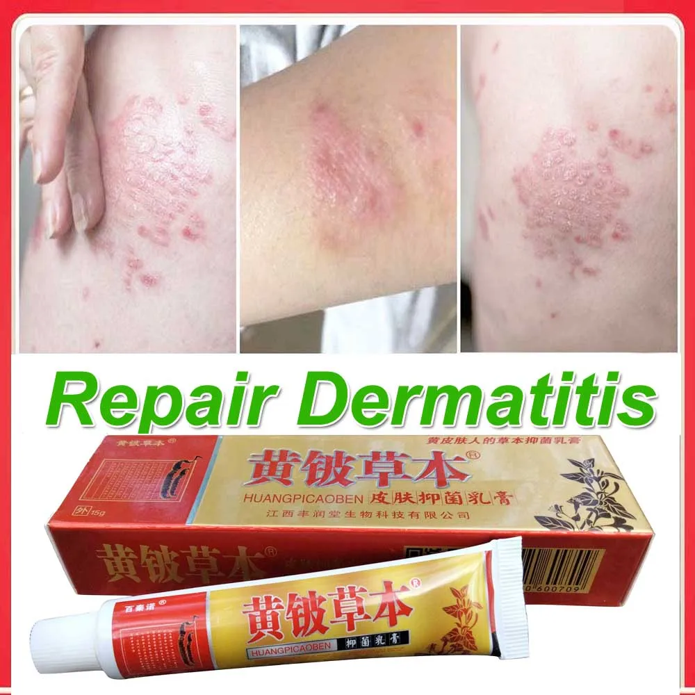 Rash Treatment Psoriasis Ointment Dermatitis Systemic Skin Eczema Blisters Folliculitis Itching Antibacterial Cream
Rash Treatment Psoriasis Ointment Dermatitis Systemic Skin Eczema Blisters Folliculitis Itching Antibacterial Cream