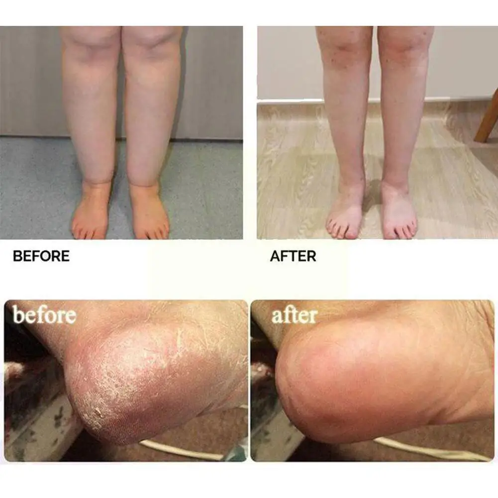 Foot Soaking Tablets Foot Bath Tablets Fungal Nail Psoriasis Relieves Beriberi Treatment Peeling Detoxification Foot Skin C B2f4
Foot Soaking Tablets Foot Bath Tablets Fungal Nail Psoriasis Relieves Beriberi Treatment Peeling Detoxification Foot Skin C B2f4
