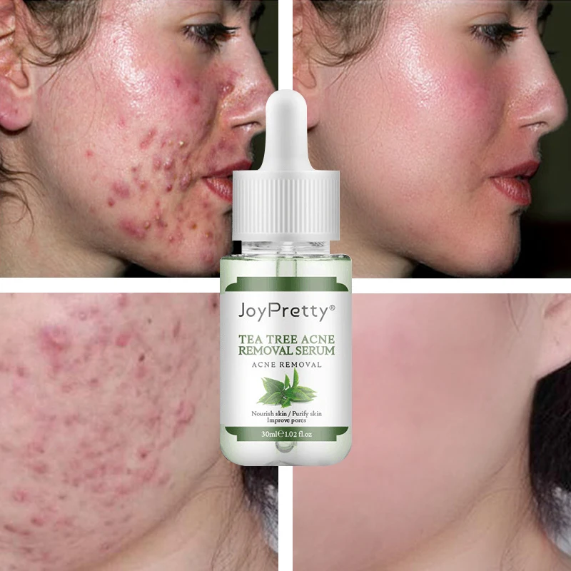Tea Tree Acne Remover Face Serum Anti Acne Oil Control Shrink Pore Moisturizing Nourish Beauty Health Repair Skin Care Products
Tea Tree Acne Remover Face Serum Anti Acne Oil Control Shrink Pore Moisturizing Nourish Beauty Health Repair Skin Care Products