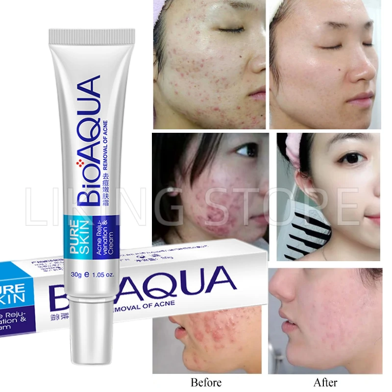 3Pcs Bioaqua Face Acne Treatment Blackhead Removal Cream 30G Oil Control Shrink Pores Scar Spot Remove Face Care Whitening Cream
3Pcs Bioaqua Face Acne Treatment Blackhead Removal Cream 30G Oil Control Shrink Pores Scar Spot Remove Face Care Whitening Cream