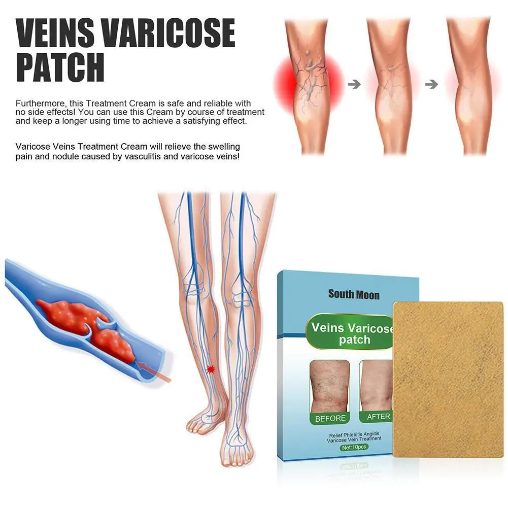 10Pcs Varicose Veins Treatment Patch Varicosity Angiitis Leg Massage Sticker Thigh Spider Removal Swelling Pain Relief Plaster
10Pcs Varicose Veins Treatment Patch Varicosity Angiitis Leg Massage Sticker Thigh Spider Removal Swelling Pain Relief Plaster