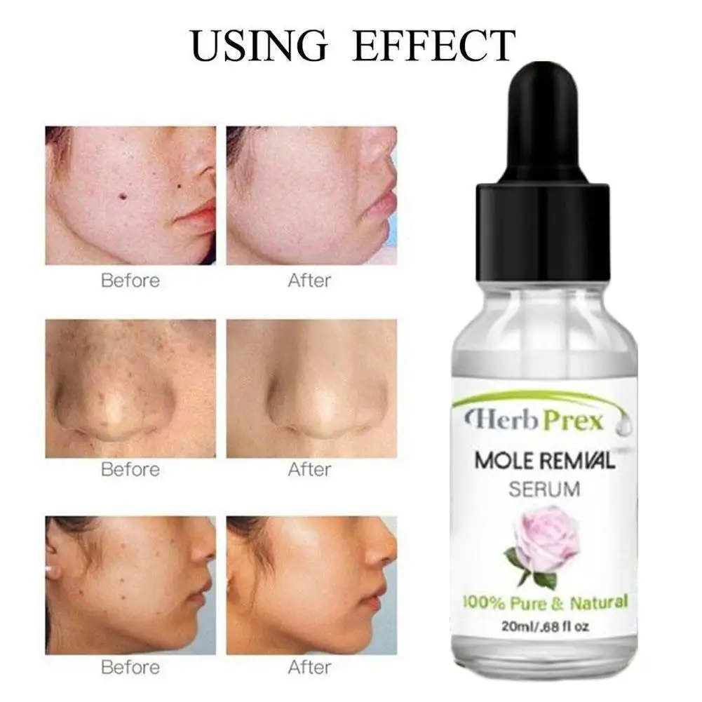 20ml Mole Skin Tag Removal Solution Painless Mole Skin Dark Spot Removal Face Wart Tag Freckle Removal Cream Oil Plaster
20ml Mole Skin Tag Removal Solution Painless Mole Skin Dark Spot Removal Face Wart Tag Freckle Removal Cream Oil Plaster
