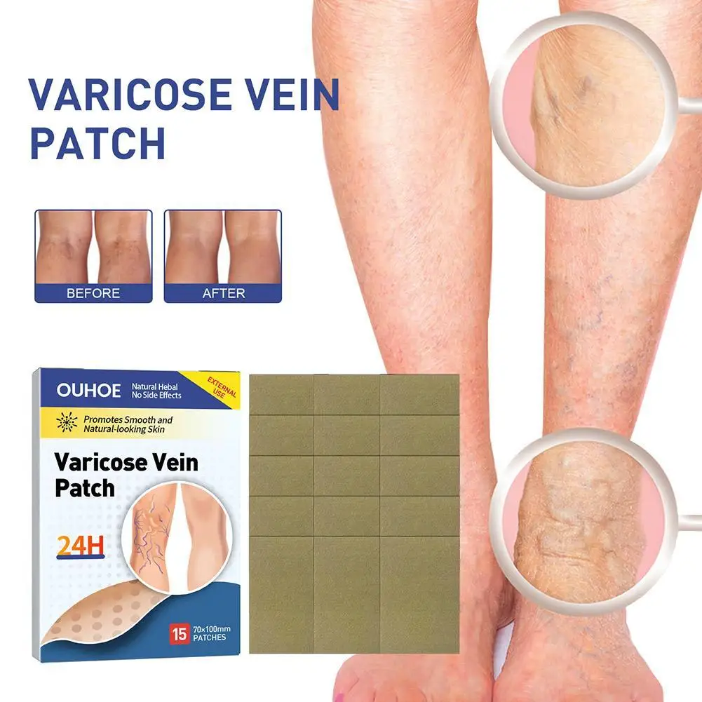15pcs Varicose Veins Medical Plaster Vasculitis Phlebitis Patch Spider Varicosity Angiitis Removal Herbal Sticker
15pcs Varicose Veins Medical Plaster Vasculitis Phlebitis Patch Spider Varicosity Angiitis Removal Herbal Sticker