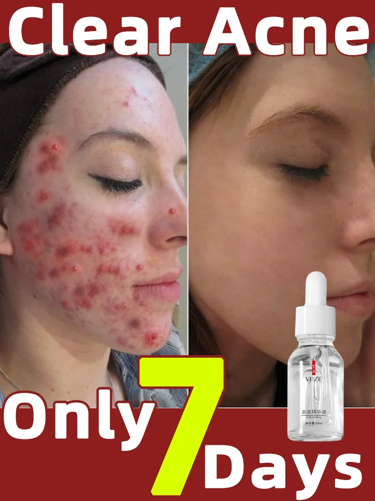 7 Day Acne Treatment Face Serum Anti Pimples Spots Scars Removal Essence Shrink Pores Oil Control Repair Korean SkinCare Product
7 Day Acne Treatment Face Serum Anti Pimples Spots Scars Removal Essence Shrink Pores Oil Control Repair Korean SkinCare Product