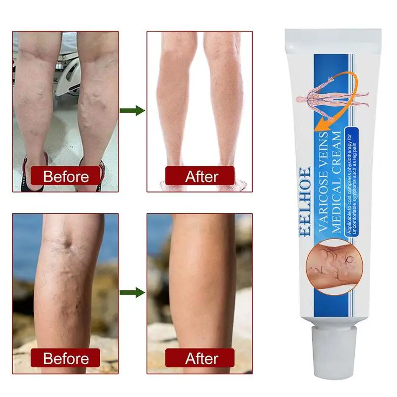 16g Varicosity Medical Varicose Veins Cream Treatment Leg Vasculitis Herbal Foot Foot Anti Massager Product Phlebitis
16g Varicosity Medical Varicose Veins Cream Treatment Leg Vasculitis Herbal Foot Foot Anti Massager Product Phlebitis