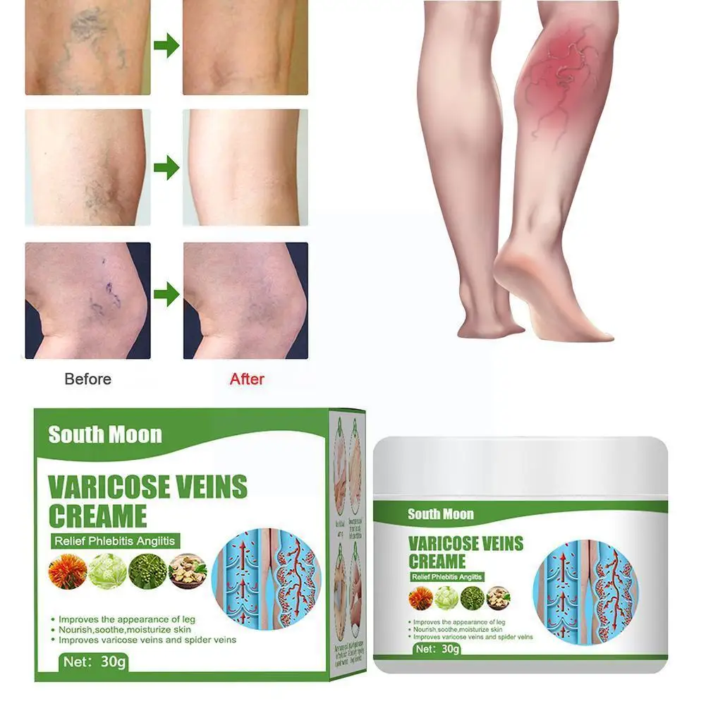 30g Varicose Vein Cream Effective Varicose Veins Relief Treatment Vasculitis Ointment Pain Cream Spider Phlebitis Relieve Z0C7
30g Varicose Vein Cream Effective Varicose Veins Relief Treatment Vasculitis Ointment Pain Cream Spider Phlebitis Relieve Z0C7