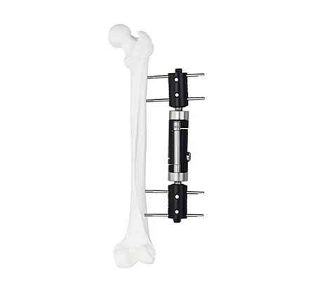 Orthopedic External Fixation Medical External Fixator Dynamic Axial External Fixator
Orthopedic External Fixation Medical External Fixator Dynamic Axial External Fixator