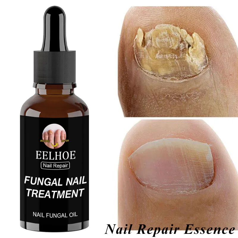 Feet Fungal Nail Repair Essence CareTreatment Foot Toe Nail Fungus Removal Gel Anti Infection Paronychia Onychomycosis Care 50ml
Feet Fungal Nail Repair Essence CareTreatment Foot Toe Nail Fungus Removal Gel Anti Infection Paronychia Onychomycosis Care 50ml
