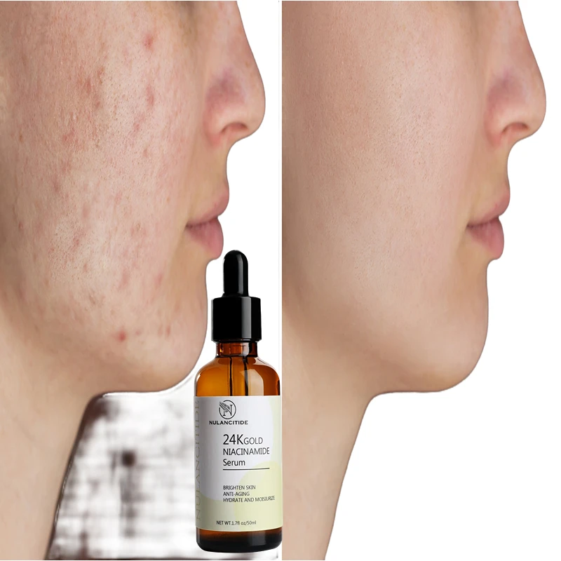 24K Gold Serum Collagen Hyaluronic Acid Anti-wrinkle Whitening Anti-aging Brighten Skin Tone Spot and Acne Skin Care Beauty Heal
24K Gold Serum Collagen Hyaluronic Acid Anti-wrinkle Whitening Anti-aging Brighten Skin Tone Spot and Acne Skin Care Beauty Heal