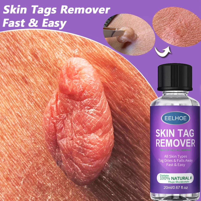 Wart Remover Skin Tag Treatment Papillomas Removal Mole Liquid Against Moles Remover Anti Verruca Remedy Care Solution Oil Cream
Wart Remover Skin Tag Treatment Papillomas Removal Mole Liquid Against Moles Remover Anti Verruca Remedy Care Solution Oil Cream