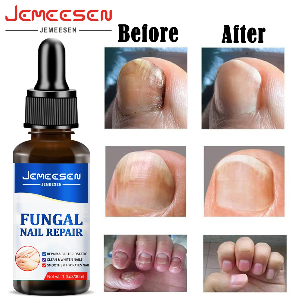 Средство для ухода за ногтями Jemeesen, сыворотка для ногтей от грибков, гель для удаления ногтей, против инфекции, Отбеливание рук и ног
Средство для ухода за ногтями Jemeesen, сыворотка для ногтей от грибков, гель для удаления ногтей, против инфекции, Отбеливание рук и ног