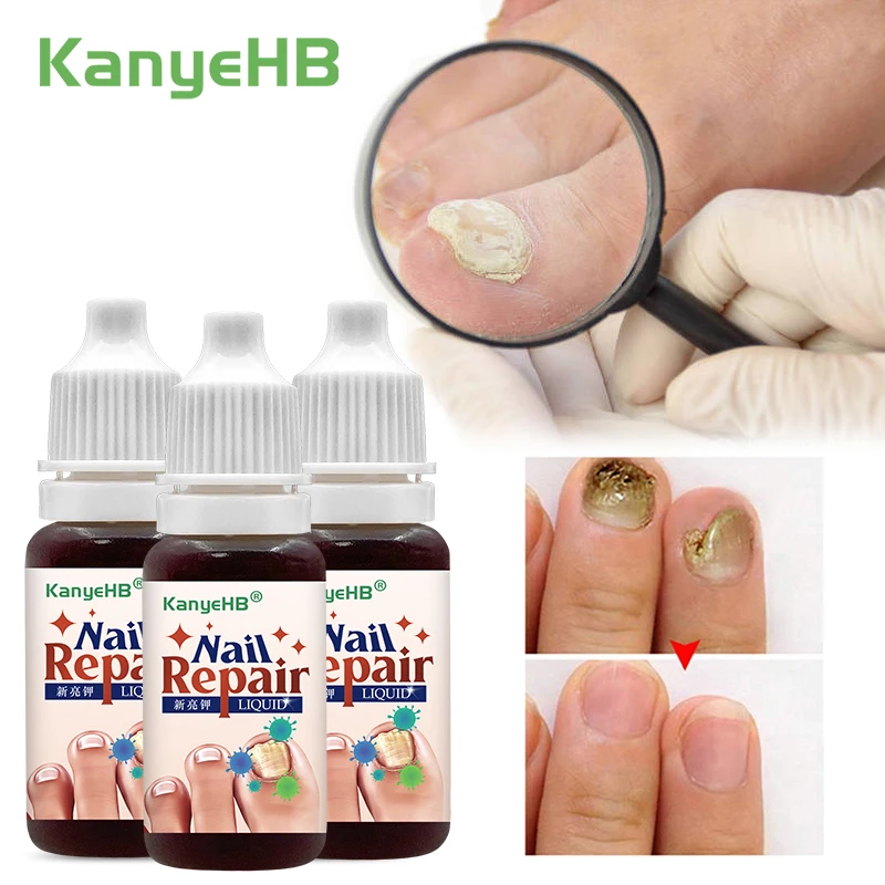 3Pcs Nail Fungus Treatment Essence Liquid Chinese Medical Extract Nail Care Anti-infective Liquid Removal Onychomycosis A1501
3Pcs Nail Fungus Treatment Essence Liquid Chinese Medical Extract Nail Care Anti-infective Liquid Removal Onychomycosis A1501