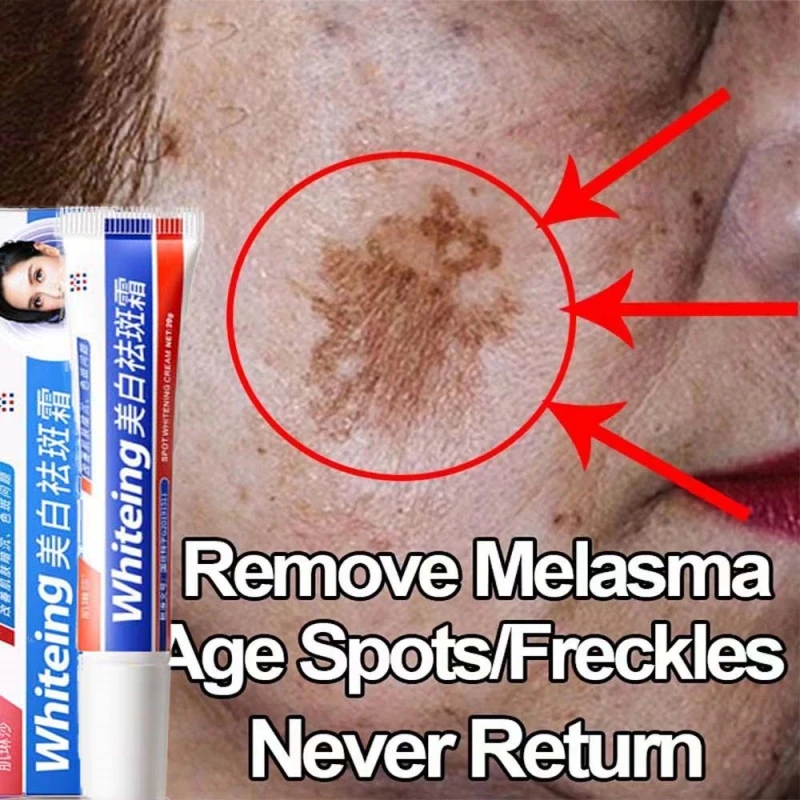 Dark Spots Whitening Cream Facial Pigment Freckles Melasma Intense Stains Remove Gel Improve Dullness Fast Brighten Skin Product
Dark Spots Whitening Cream Facial Pigment Freckles Melasma Intense Stains Remove Gel Improve Dullness Fast Brighten Skin Product