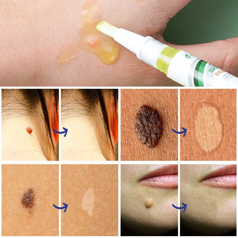 2pcs Effective Skin Tag Remover Fast Remove Mole & Genital Wart Anti Foot Corn Removal Warts Papillomas Rapidly Removes Moles
2pcs Effective Skin Tag Remover Fast Remove Mole & Genital Wart Anti Foot Corn Removal Warts Papillomas Rapidly Removes Moles