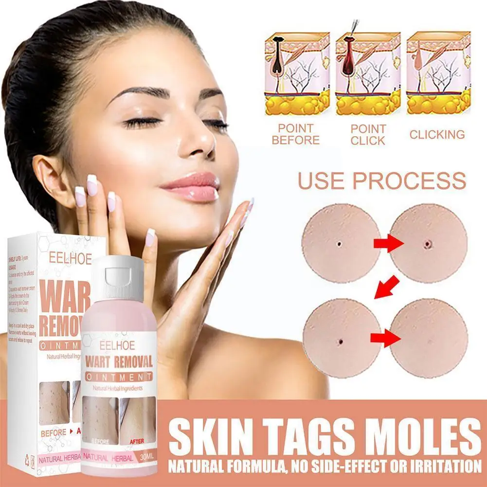 30g Wart Removal Cream Freckle Cream Remove Melasma Acne Remover Cream Tag Spots Melanin Spot Dark Moisturizing Ointment Sk G6h7
30g Wart Removal Cream Freckle Cream Remove Melasma Acne Remover Cream Tag Spots Melanin Spot Dark Moisturizing Ointment Sk G6h7