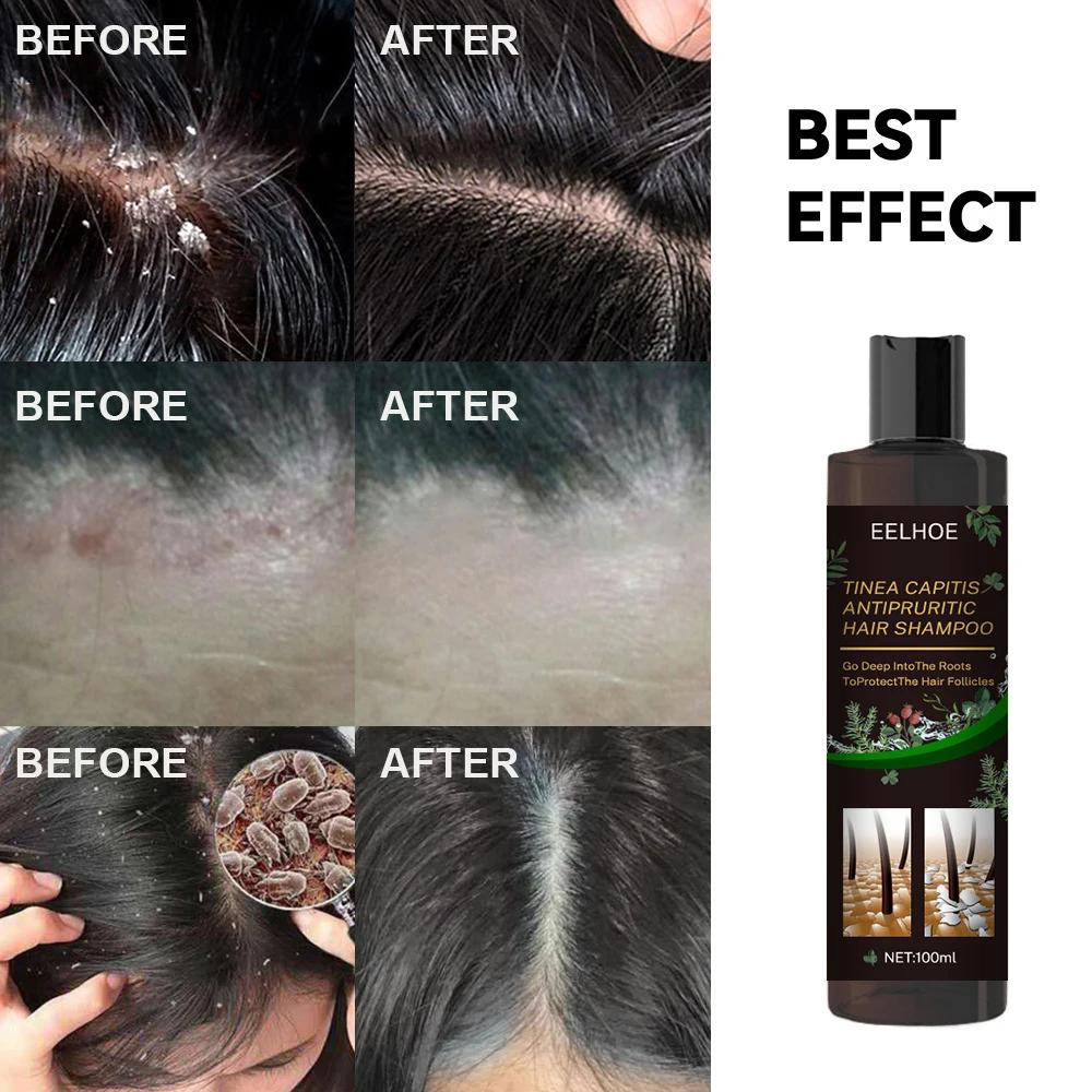 

Anti Dandruff Oil Control Anti Itching Shampoo Anti Hair Loss Remove Head Moss Refreshing Shampoo Improve Seborrheic Dermatitis