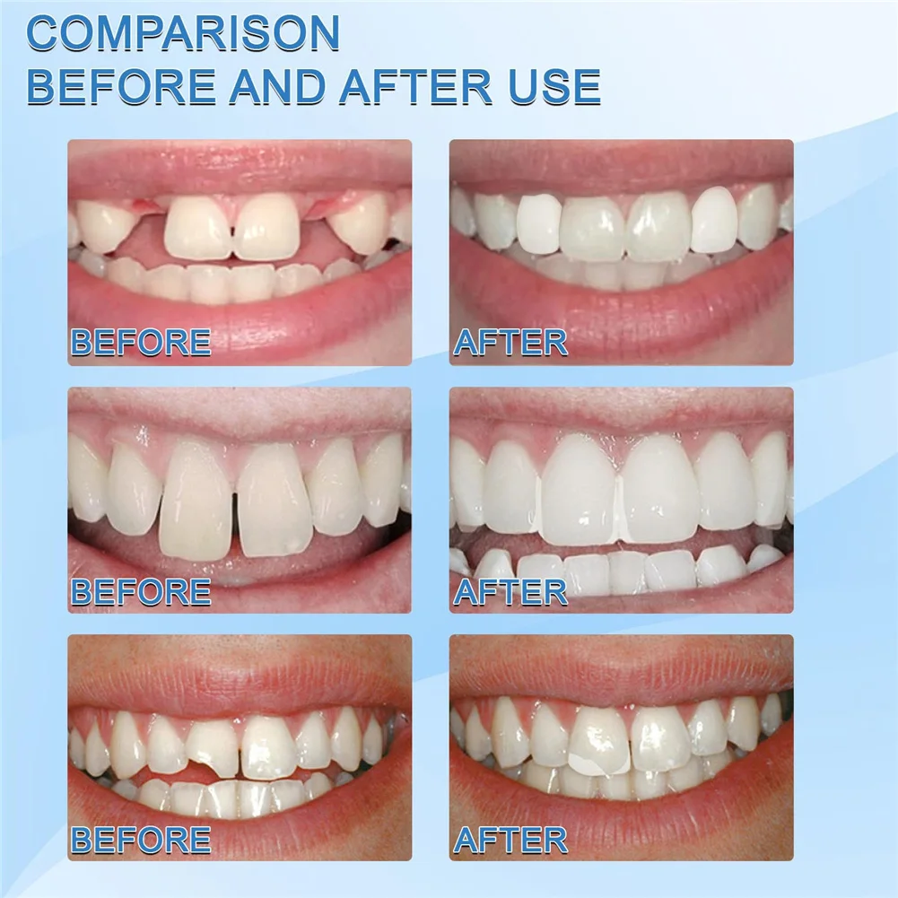 Temporary Tooth Repair Kit False Teeth Solid Glue Denture For Missing Broken Teeth Moldable Tooth Filling False Teeth
Temporary Tooth Repair Kit False Teeth Solid Glue Denture For Missing Broken Teeth Moldable Tooth Filling False Teeth