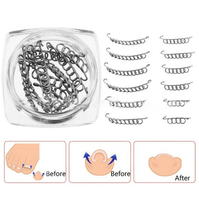 Fashion New 12pcs Ingrown Toe Nail Correction Wire Fixer Pedicure Paronychia Recover Toenails Corrector Foot Care Tool
Fashion New 12pcs Ingrown Toe Nail Correction Wire Fixer Pedicure Paronychia Recover Toenails Corrector Foot Care Tool