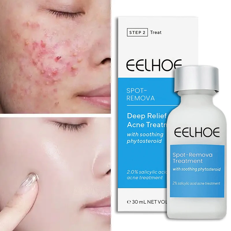 Get Rid of Acne and Fade Spots Facial Lotion Vitamin B3 B5 Extract Smooth Skin Repairs Brightens The Skin Tone Moisturizing 30ml
Get Rid of Acne and Fade Spots Facial Lotion Vitamin B3 B5 Extract Smooth Skin Repairs Brightens The Skin Tone Moisturizing 30ml