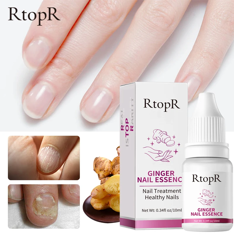 Fungal Nail Treatment Feet Care Essence Nail Foot Whitening Toe Nail Fungus Removal Gel Anti Infection Paronychia Onychomycosis
Fungal Nail Treatment Feet Care Essence Nail Foot Whitening Toe Nail Fungus Removal Gel Anti Infection Paronychia Onychomycosis
