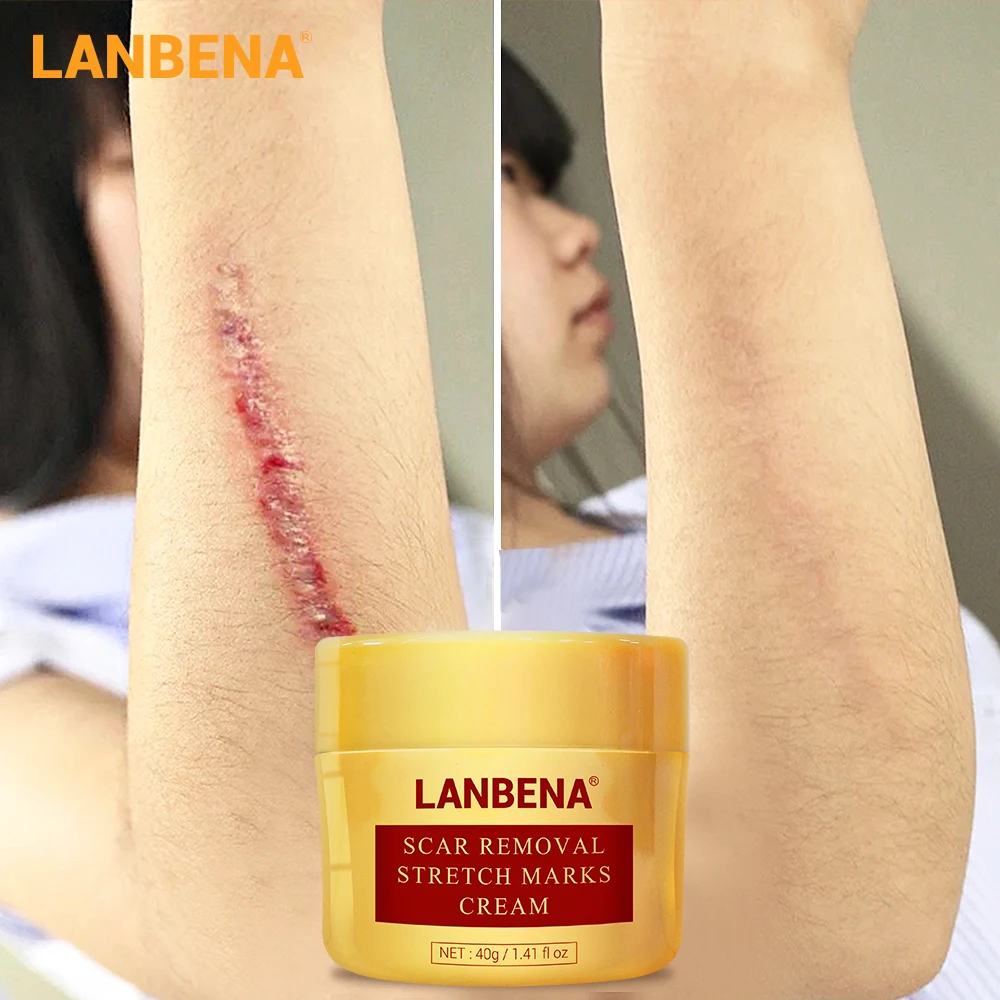 

Крем LANBENA для удаления шрамов, лечение акне, восстановление, сужение пор, отбеливание, увлажнение, уход за кожей, крем 40 г