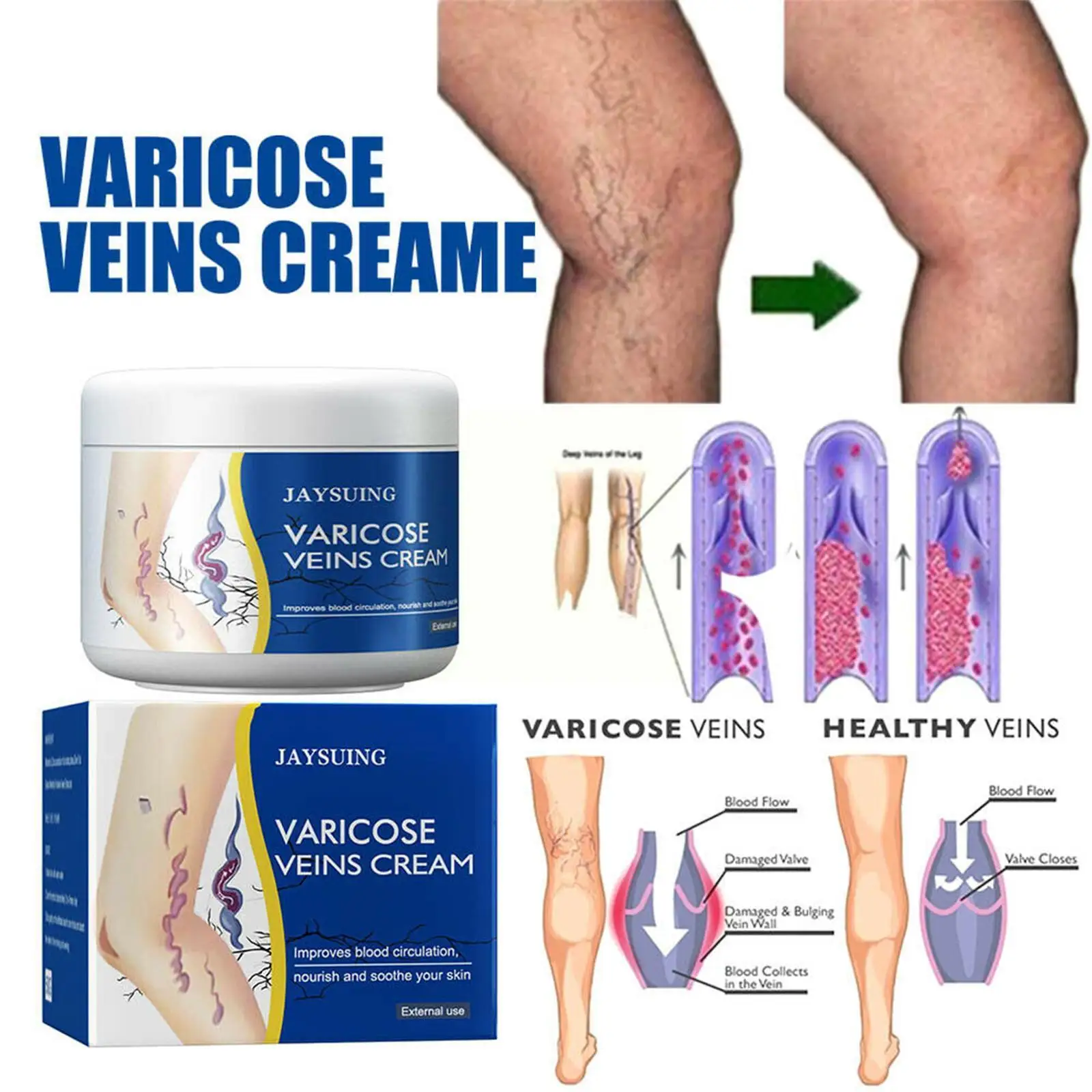 50g Varicose Veins Treatment Ointment Cream Relief Herbal Vasculitis Veins Leg Health Pain Medical Plaster Spider Care Phle T7I7 
50g Varicose Veins Treatment Ointment Cream Relief Herbal Vasculitis Veins Leg Health Pain Medical Plaster Spider Care Phle T7I7