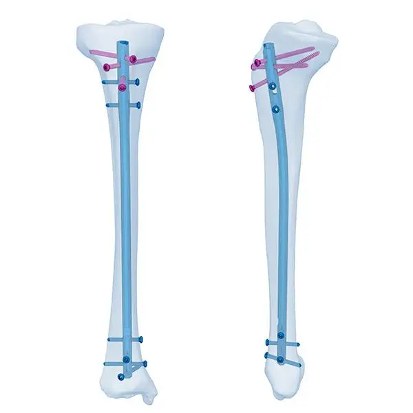 

Meditech CE&ISO certification Orthopedic Surgical tibial implant bone Titanium interlocking Expert Tibia Intramedullary Nail