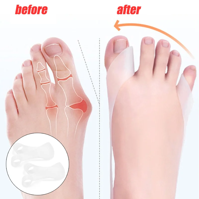 Big Toe Hallux Valgus Corrector Orthotics Feet Care Bone Thumb Adjuster Correction belt
Big Toe Hallux Valgus Corrector Orthotics Feet Care Bone Thumb Adjuster Correction belt