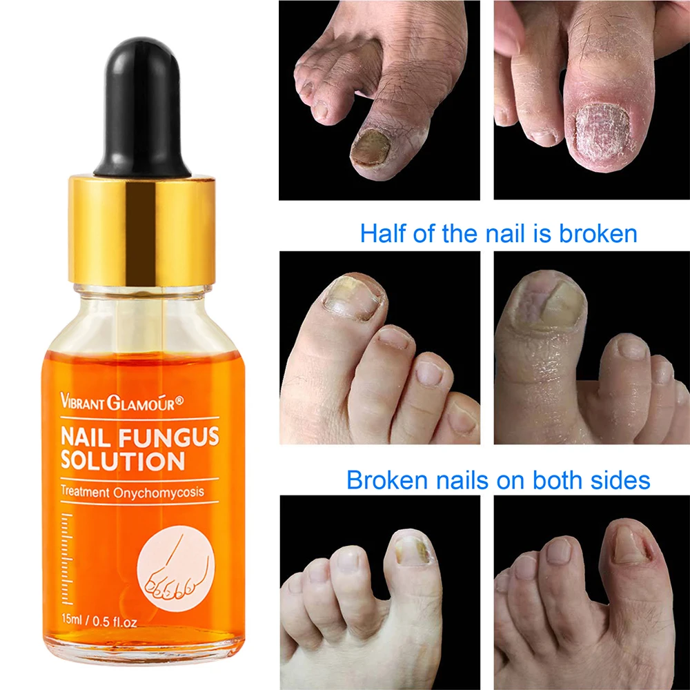

Антигрибковое Лечение ногтей эфирное масло для рук, ног, ногтей, без микробов, сыворотка, удаление грибка для ногтей, инфекция, уход за ногами, лак для ногтей